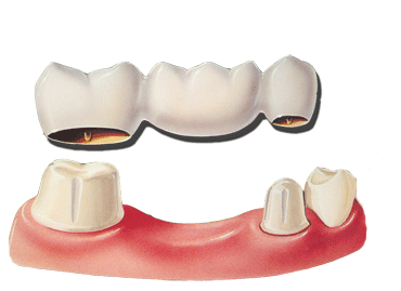 Dental Bridge