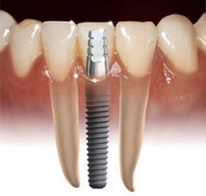 Dental Implant Photo